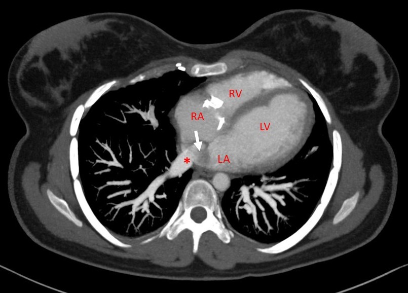 CT Angiography Axial MPR (Multiplanar Reformation) image- IVC (white arrow) seen opening into left atrium close to opening of right inferior pulmonary vein (red star). (abbreviation: RA- right atrium, LA- left atrium, RV- right ventricle, LV- left ventricle).