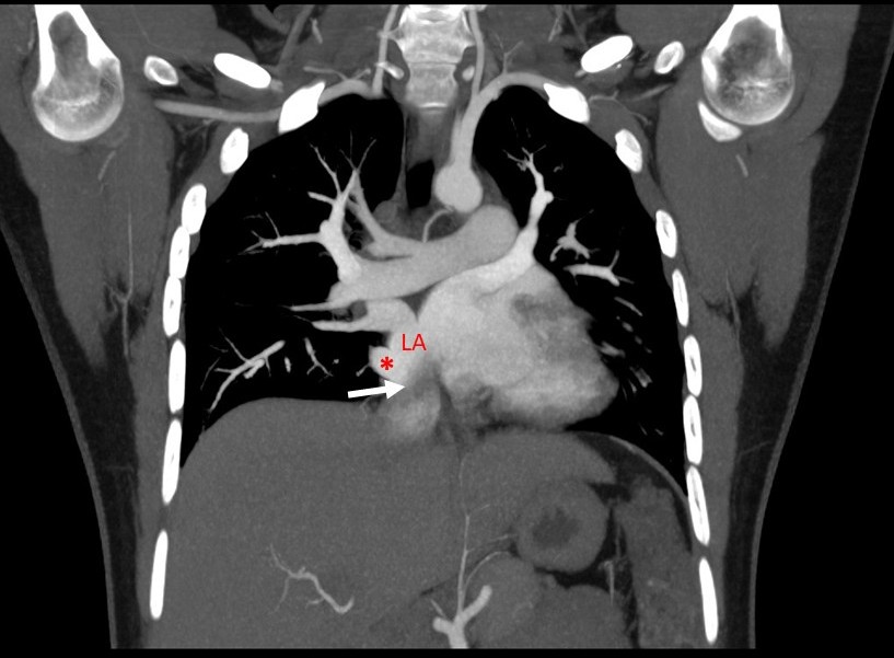 CT Angiography Coronal MPR image- IVC (white arrow) seen opening into left atrium (LA) close to opening of right inferior pulmonary vein (red star).