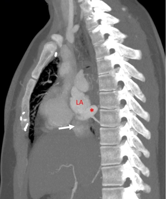 CT Angiography Sagittal MPR image- IVC (white arrow) seen opening into left atrium (LA) close to opening of right inferior pulmonary vein (red star).