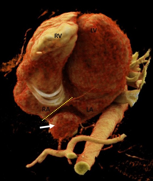 CT Angiography Cinematic VRT (Volume Rendering Technique) reconstruction demonstrating the relationship between the surgical patch (yellow dotted line) and the redirected IVC pathway (white arrow) into the left atrium. (abbreviation: RA- right atrium, LA- left atrium, RV- right ventricle, LV- left v