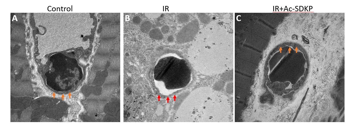 Effects of radiation and Ac-SDKP on the myocardial coronary vasculature examined by transmission electron microscopy (acute study). Representative images from control, IR, and IR + Ac-SDKP–treated mouse hearts show coronary vasculature with radiation-induced endothelial injury characterized by nucle