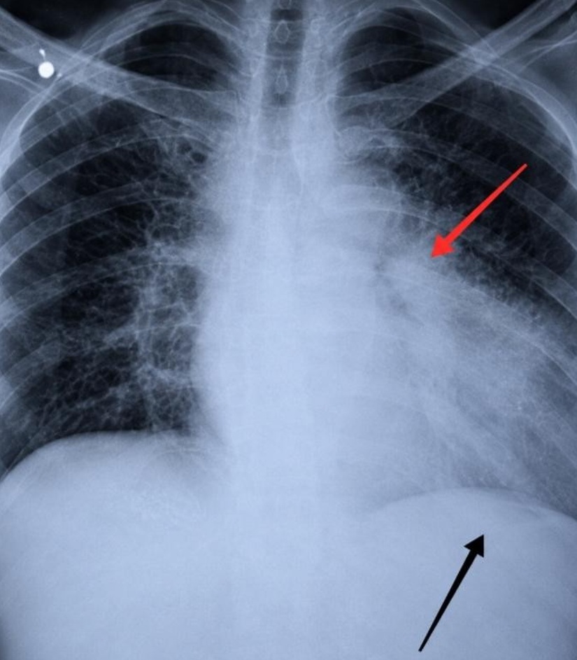 Chest radiograph demonstrating marked cardiomegaly with widening of the carinal angle (2 arrows), consistent with giant left atrial enlargement.