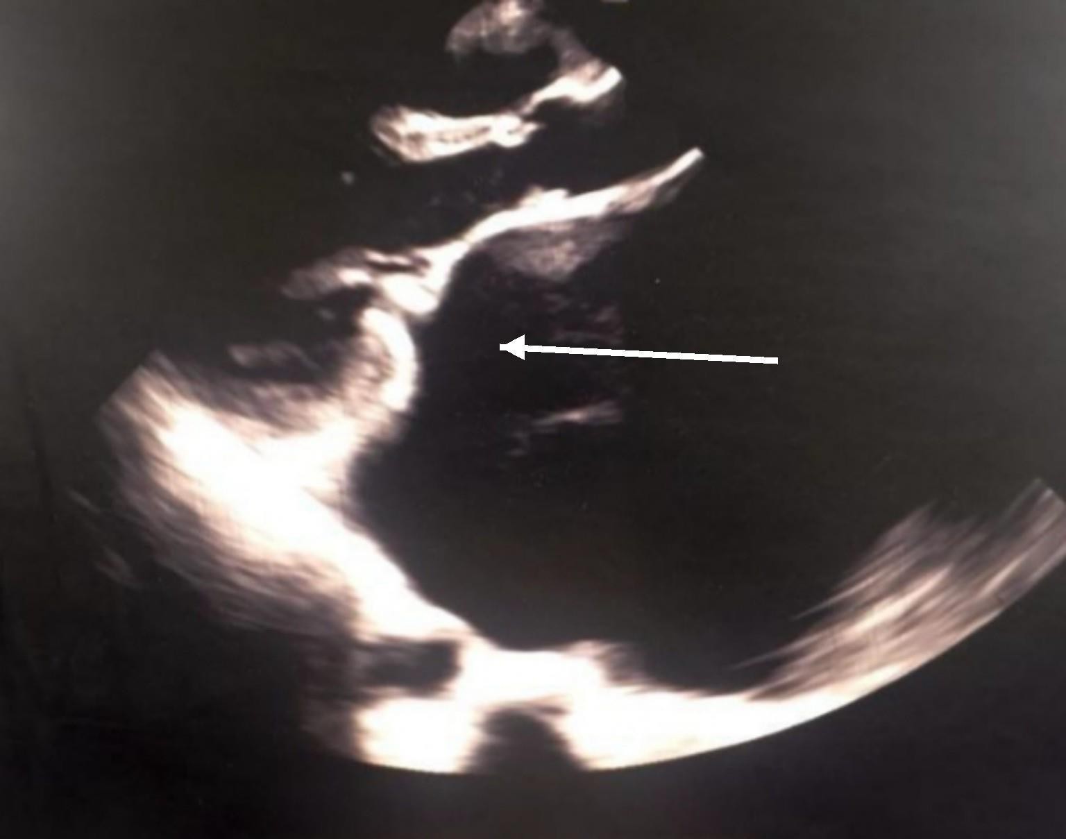 Transthoracic echocardiography showing rheumatic thickening of the mitral valve leaflets.