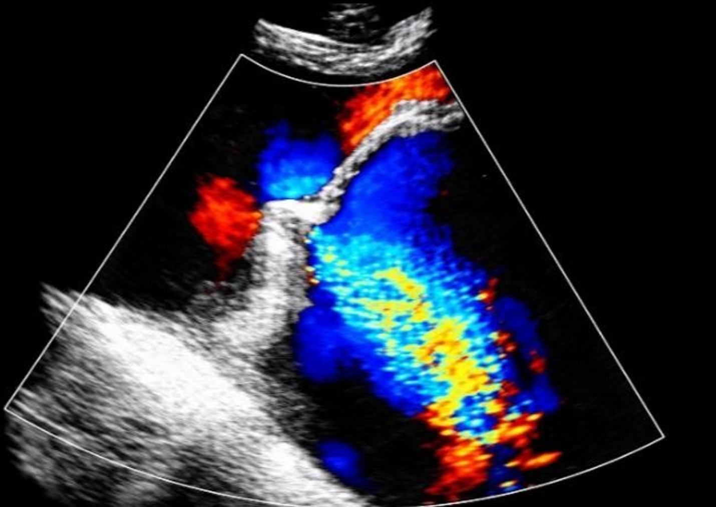 Color Doppler echocardiography demonstrating a severe eccentric posterolateral mitral regurgitant jet.