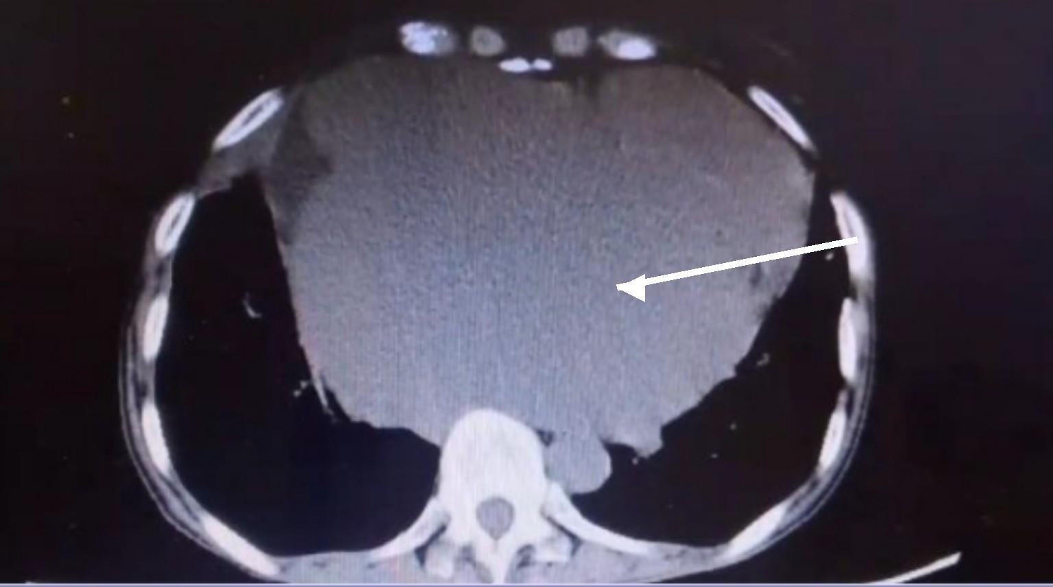 Contrast-enhanced CT of the chest showing giant left atrial enlargement causing posterior mediastinal mass effect with anterior displacement and compression of the thoracic esophagus.