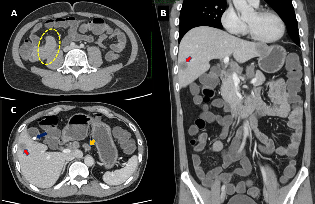 Computed tomography images. (A) Axial image with a grossly enlarged and thickened appendix (yellow dotted circle). (B) Coronal image demonstrating the hypodense lesion in the right lobe of the liver (red arrow). (C) Axial image revealing hepatic lesion (red arrow), gallstone (blue arrow), and intra-