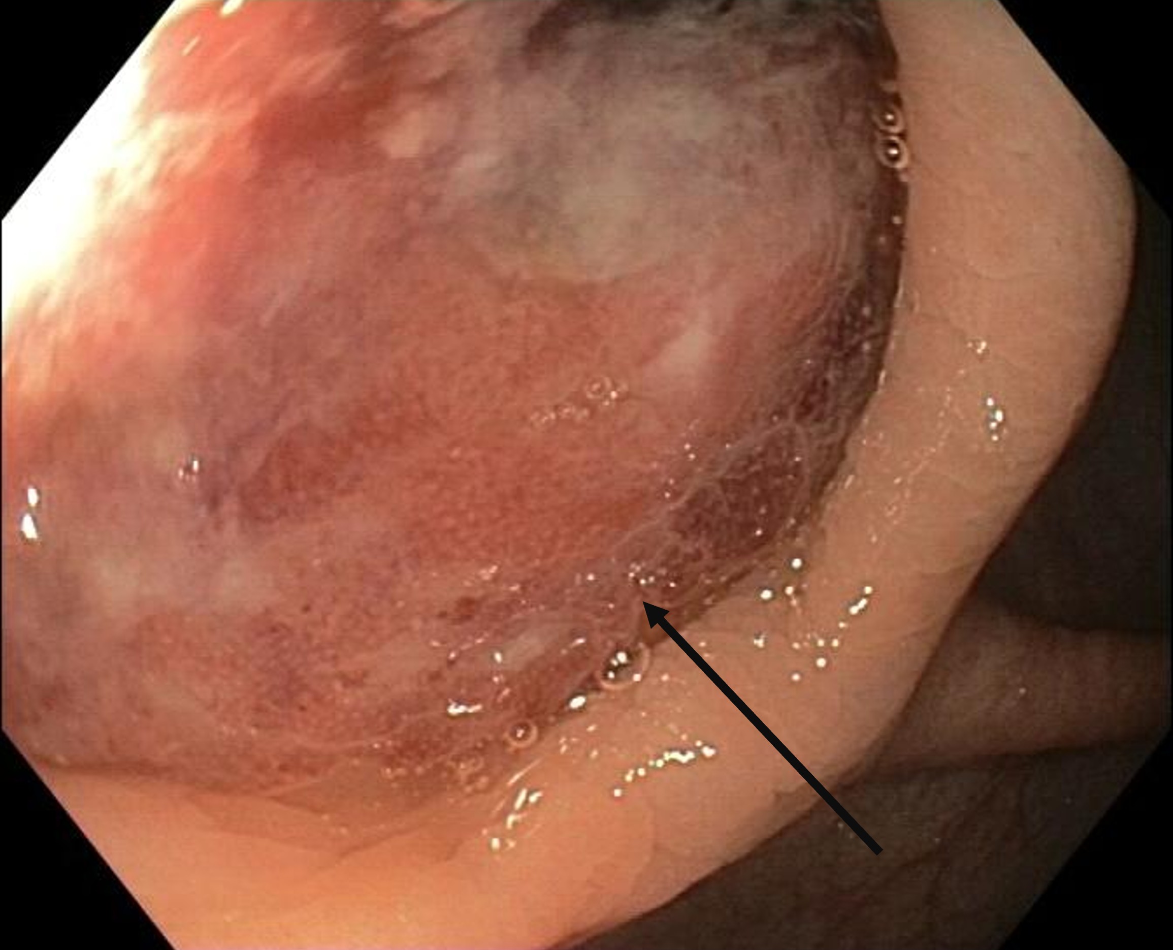 Colonoscopy demonstrating an ulcerating mass, bulging from the appendicular lumen.