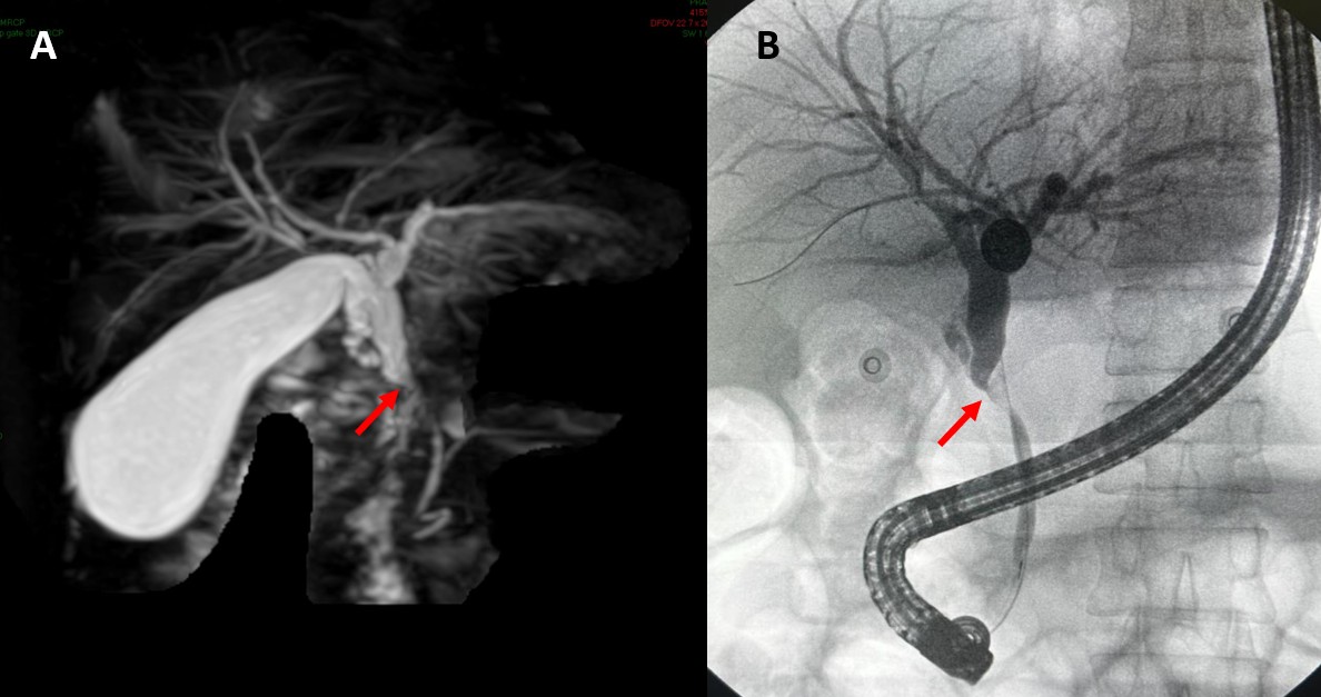 Magnetic resonance cholangiography (A) and Endoscopic retrograde cholangiography (B) revealed compressive narrowing of the mid-common bile duct with upstream dilatation (red arrows).