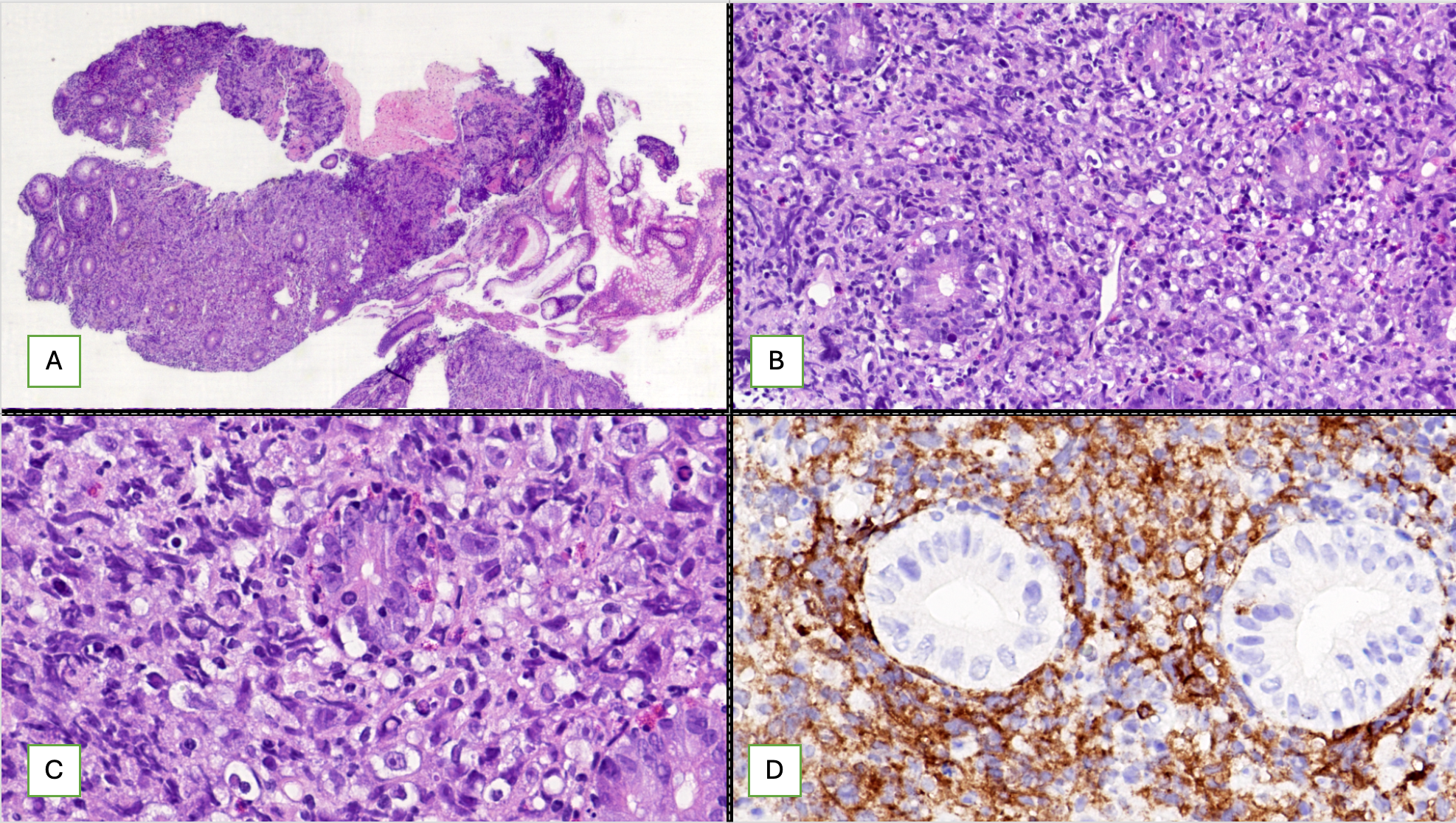 (A) Hematoxylin/eosin staining (100x): mucosal ulceration with fibrinous exudates, distortion of normal crypt architecture, crypt loss, and infiltration of lamina by sheets of atypical cells. (B) Hematoxylin/eosin staining (200x): medium to large-sized atypical cells with coarse chromatin, conspicuo