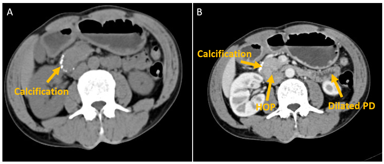 Axial sections: A) Plain CT scan showing presence of hyperdense calcific lesion in the head of the pancreas. B) CECT showing bulky head of pancreas (HOP) with features suggestive of chronic calcific pancreatitis, dilated pancreatic duct, and presence of foci of calcification.