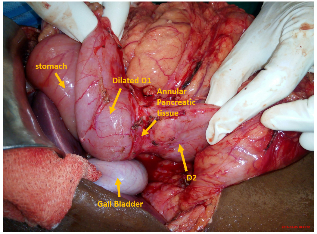 Intra-operative imaging showed dilated D1 due to distal compression by the annular pancreatic tissue encircling D2.