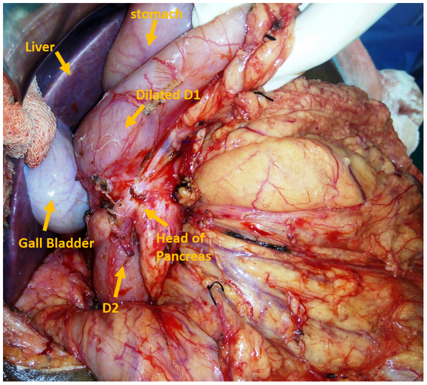 Intra-operative finding- Imaging showing annular pancreatic tissue encircling the duodenum, causing dilation in the proximal part along with other visible visceral organs.
