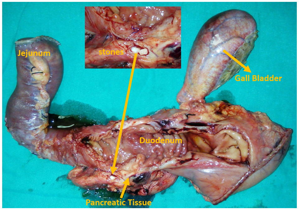 Macroscopic investigation- The cut-section of the resected specimen revealed the presence of a stone in the annular pancreatic tissue (pancreato-lithiasis) along with the resected gall bladder and jejunum. Stapler lines are visible in the specimen.