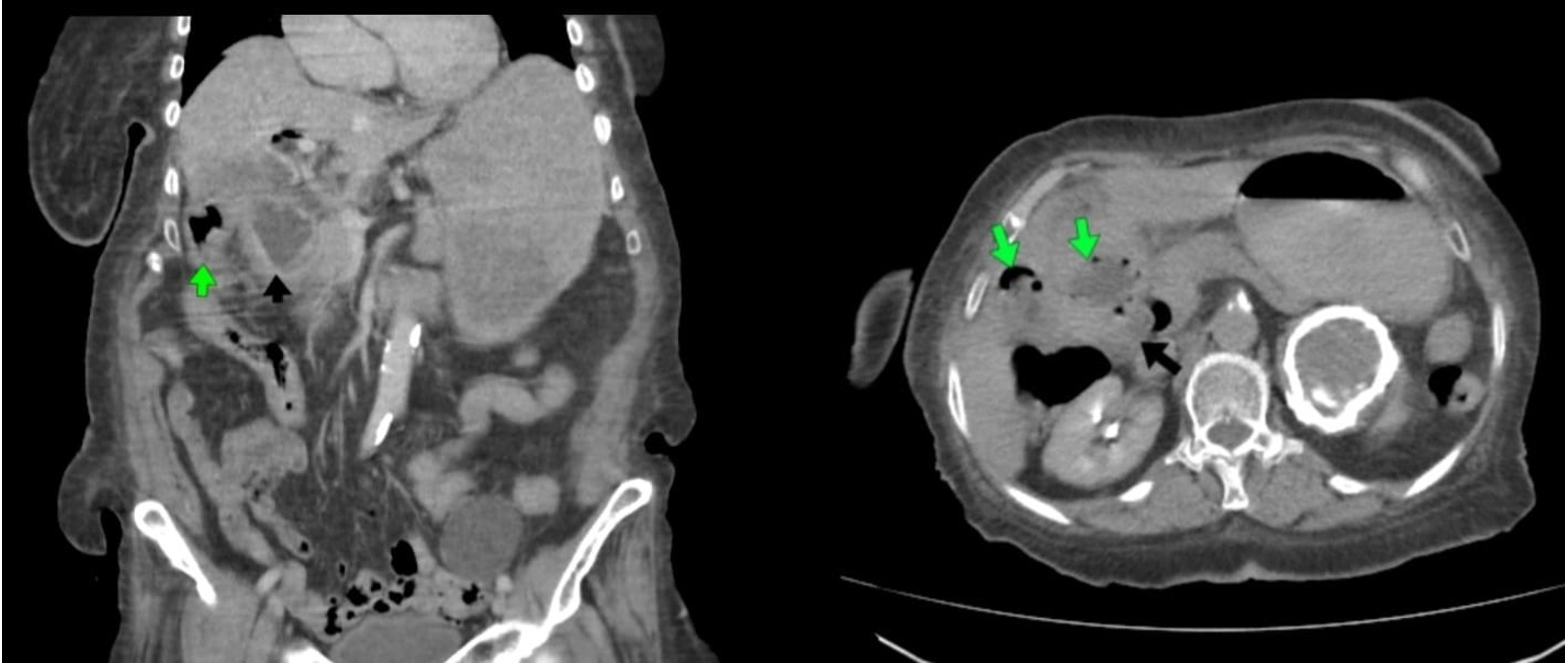 Multislice CT of the abdomen with oral and IV contrast showing a partially distended, irregular gall bladder containing multiple gas vacuoles (green arrows), which are seen compressing the second part of the duodenum (black arrows) with a fistulous track in between, excreting proximal dilation of th