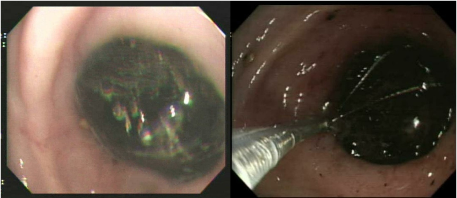 Endoscopic picture showing a large stone obstructing the pyloric ring with a trial to remove it using a Retrieval Basket (Boston Scientific).
