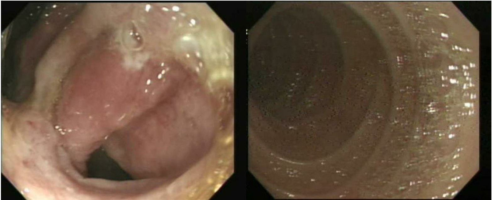 The pyloric ring, duodenal bulb, and second part of the duodenum are shown after the removal of the stone.