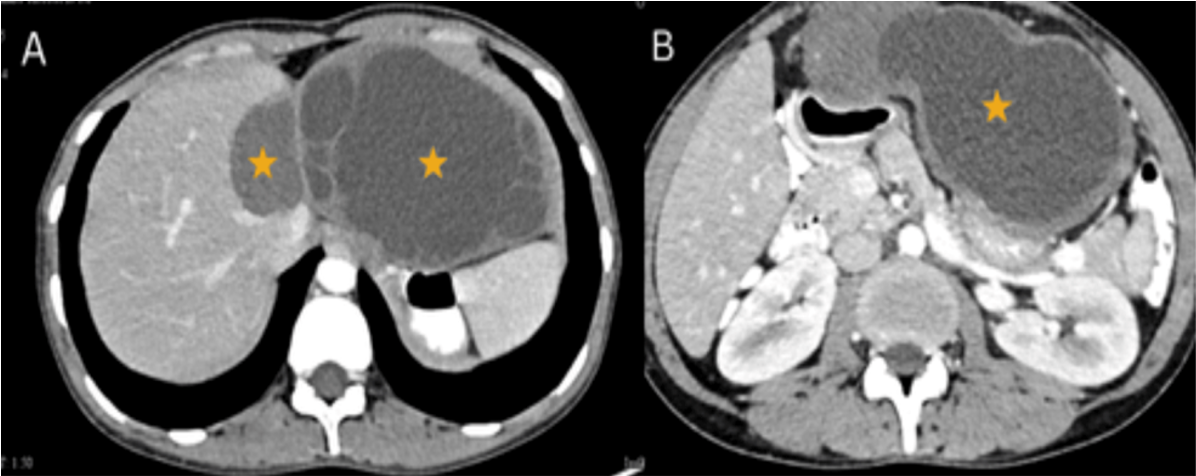 (A) Cystic structure visualized in segment IV (WHO Stage CE-4) of the liver. Another large exophytic hypodense cyst (WHO Stage CE-2) with multiple small locations scattered at its periphery (s/o daughter cysts). (B) A focal loculated extension of the Hepatic cystic lesion along its infero-medial wal