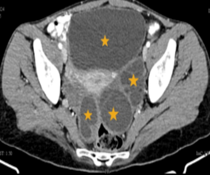 Axial section presence of well-defined cysts in the Recto-uterine pouch, Left Adnexa, and infero-medial extension of the Hepatic cyst.