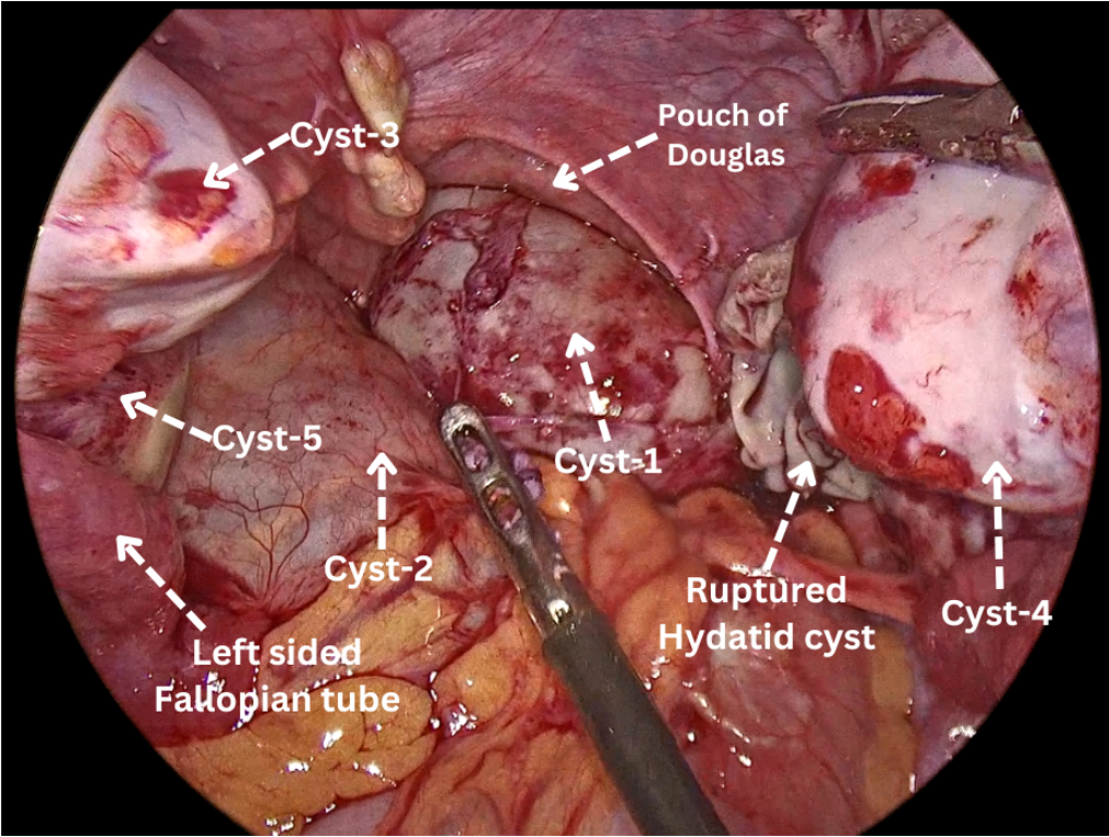 Intra-operative findings- Multiple cysts identified in the cul-de-sac, right and the left fornix which were excised using harmonic. One ruptured hydatid cyst was also identified in the right fornix with intact membranes.