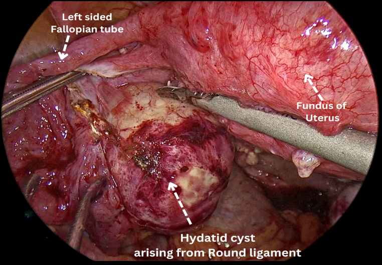 Intra-operative findings- Another cyst was identified arising from round ligament which was meticulously dissected.