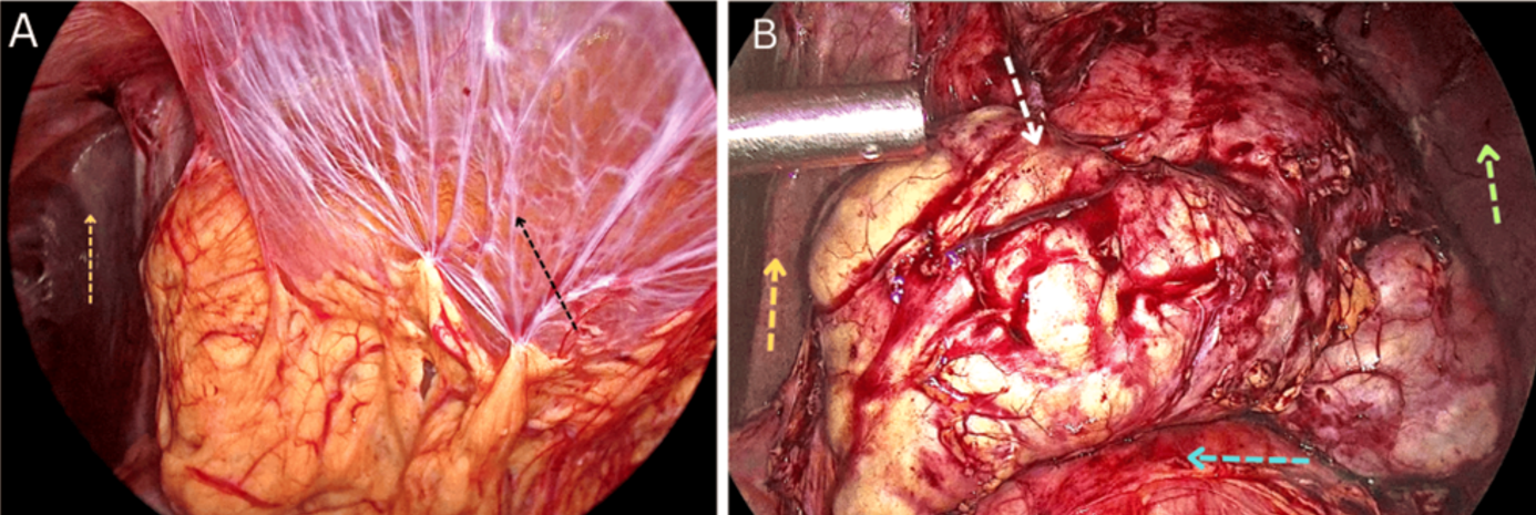 Intra-operative findings- (A) Extensive omental adhesion adhered to the anterior abdominal wall visualized (Black arrow). Right lobe of liver was also visible (Yellow arrow). (B) Cyst visualized after adhesiolysis (White arrow), Spleen (Green arrow), Right Liver lobe (Yellow arrow), Transverse Colon