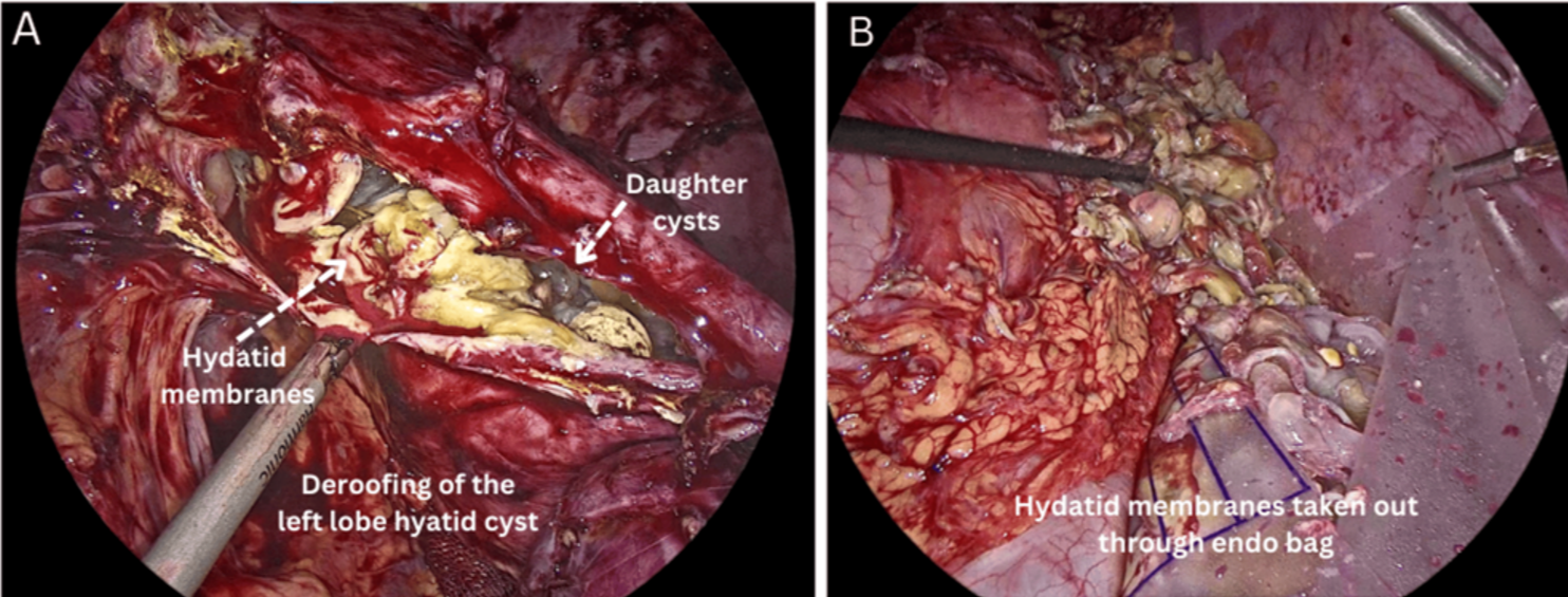 Intra-operative imaging- (A) Visible intact Hydatid membranes and Daughter cysts. (B) Cyst membranes, along with daughter cysts, are delivered out using an Endo bag.