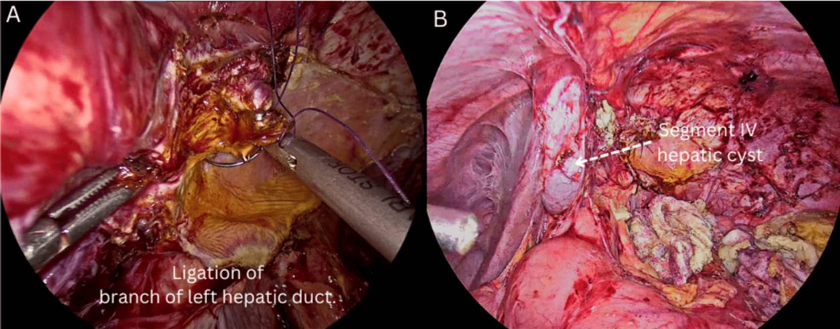 Intra-operative findings (A) Bile leak identified over the tissue of left lobe, which was ligated using ligaclip 400 & vicryl suture. (B) Another cyst was identified in segment IV of the liver.