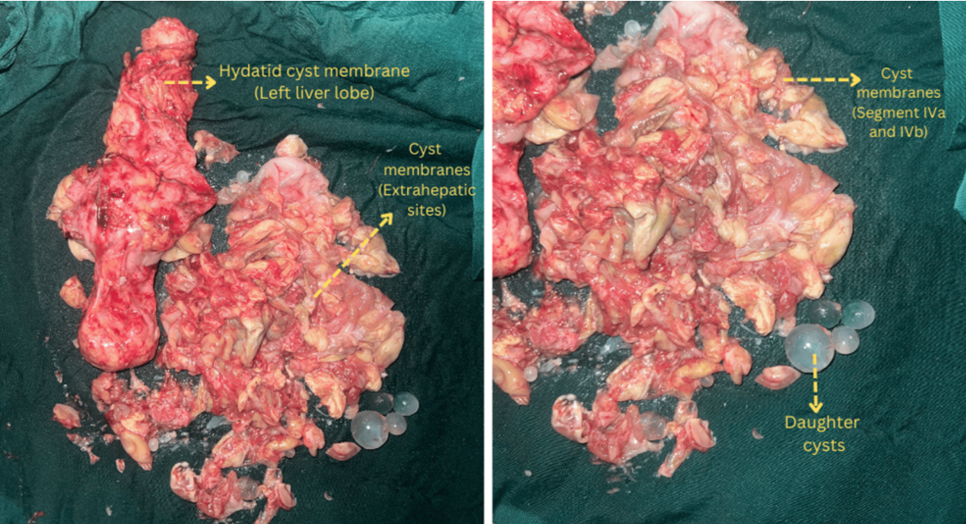 Specimen- Hydatid cyst can be visualized with intact membranes and daughter cysts.