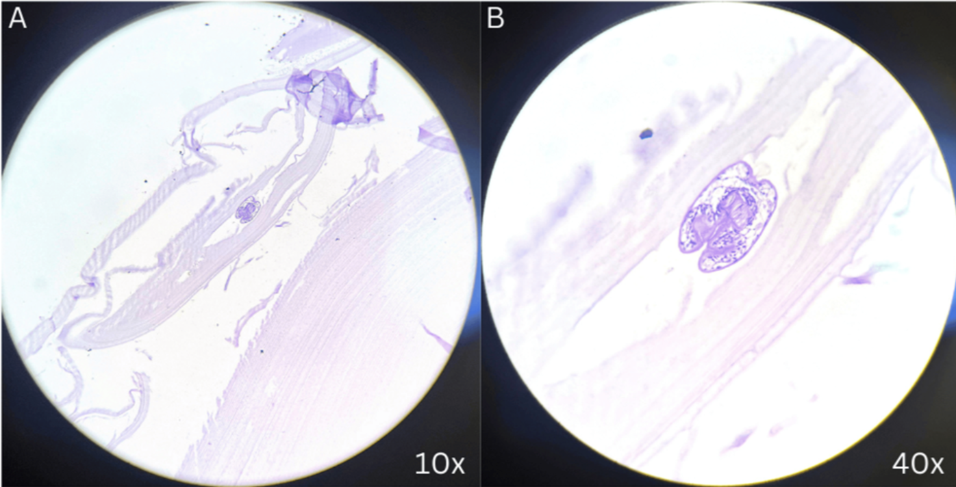 (A) Examination under 10x magnification revealed cyst wall tissue lined by cuboidal lining epithelium with mixed inflammatory infiltrates. (B) Examination under 40x magnification revealed scolices, protoscolioses, and acellular laminated membranes with debritic material