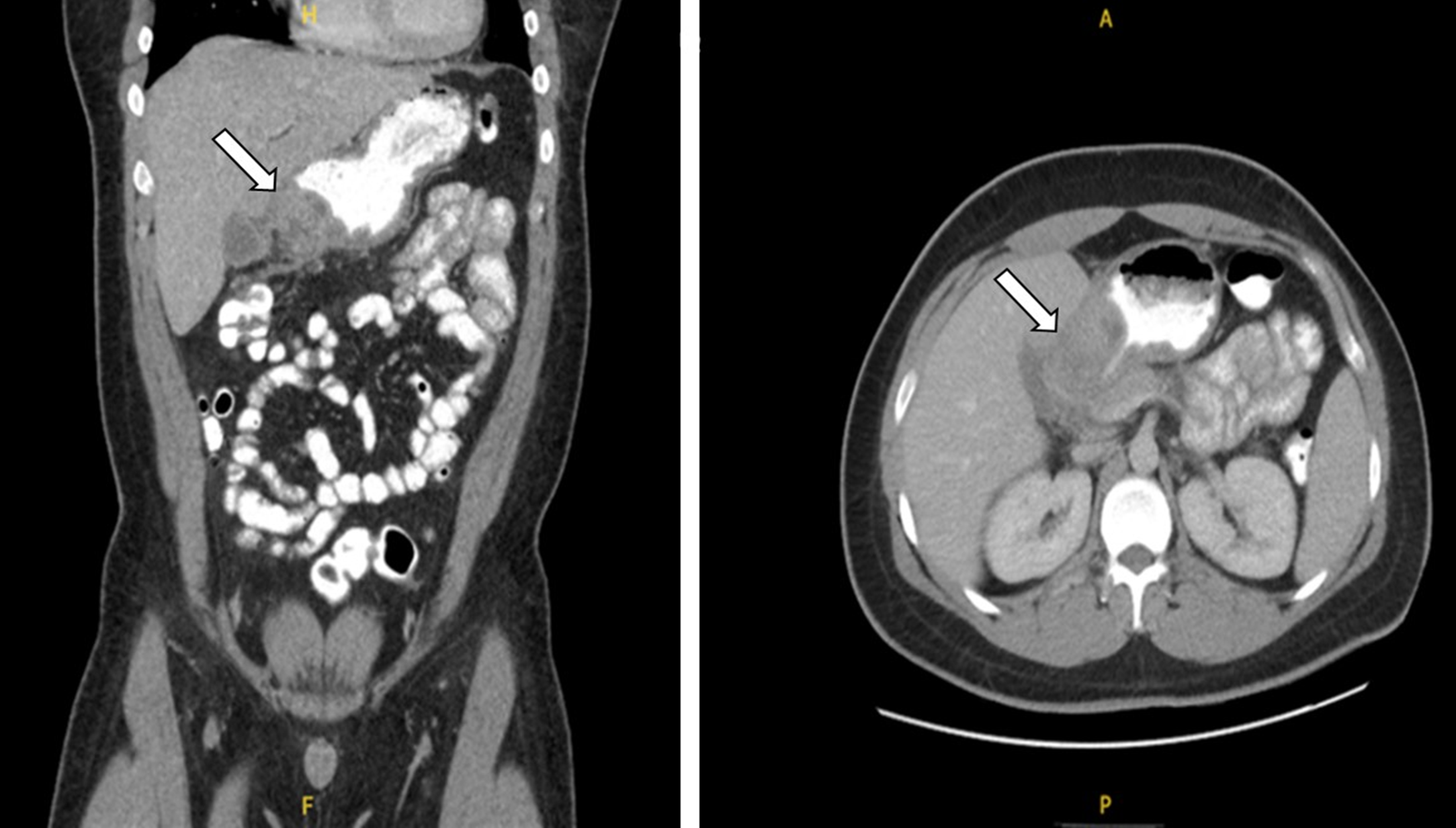 Mass-like thickening of the wall of the gastric antrum with luminal compression and adjacent stranding.