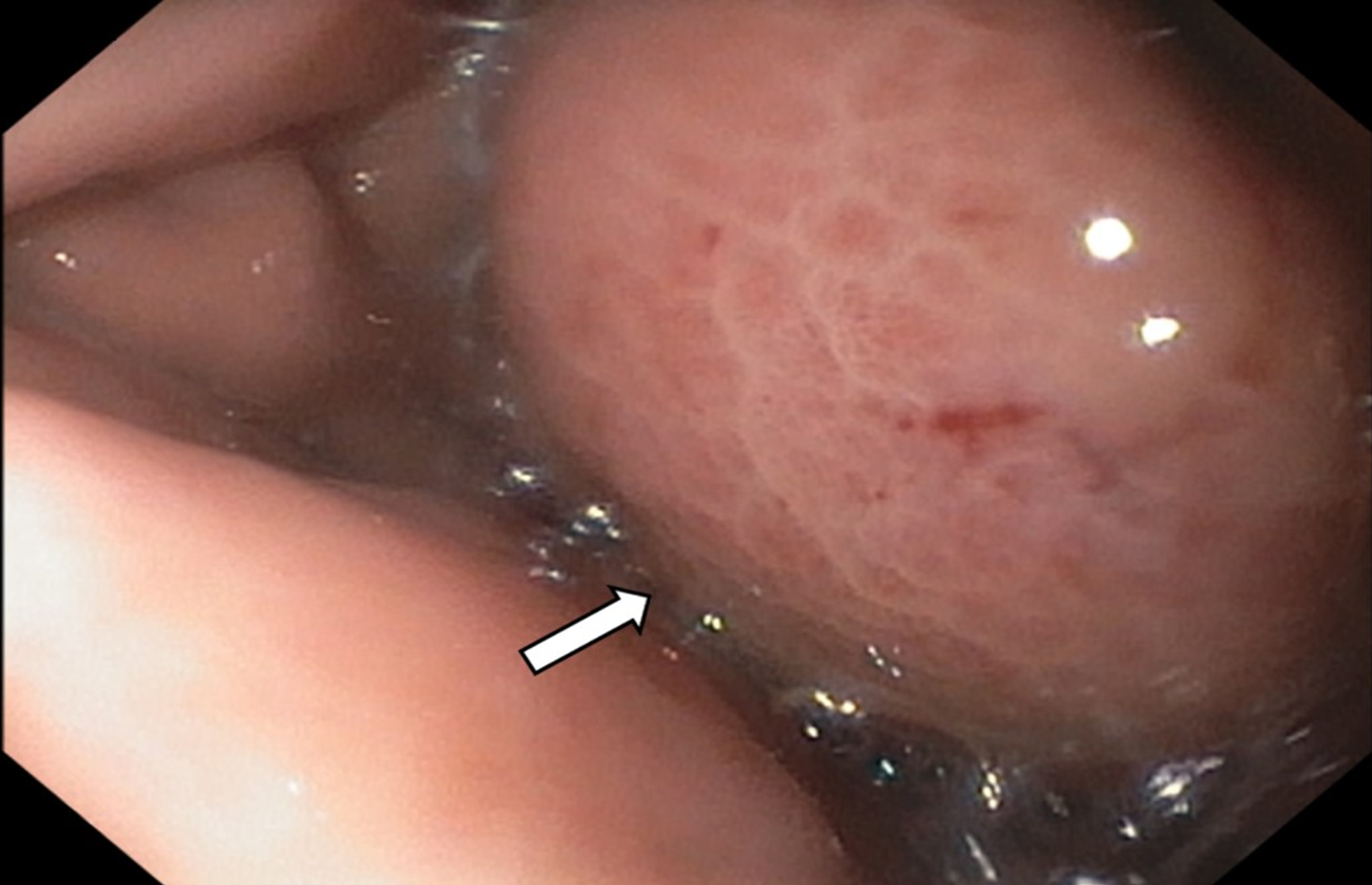 Large subepithelial extrinsic compression towards the antrum. Suspected fluid collection, possibly a walled-off abscess on the other side of this. No clear ulceration was seen.
