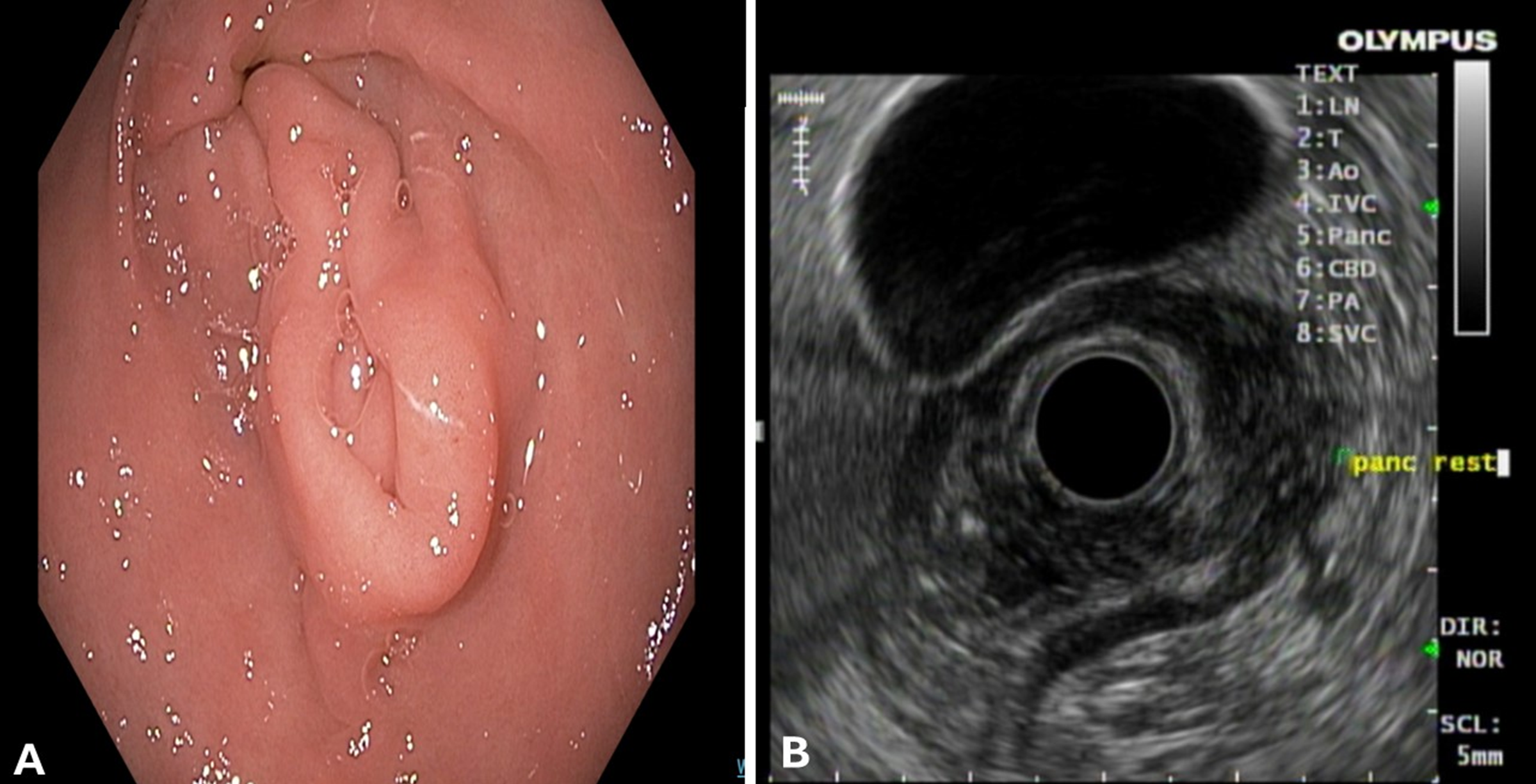A: Antral nodule with redundant folds General appearance consistent with pancreatic rest. B: Area of thickened fold. The muscularis propria thickened to 12 mm with an extended area of heterogenous echo-texture extending from the muscularis propria to the submucosa, consistent with pancreatic rest.