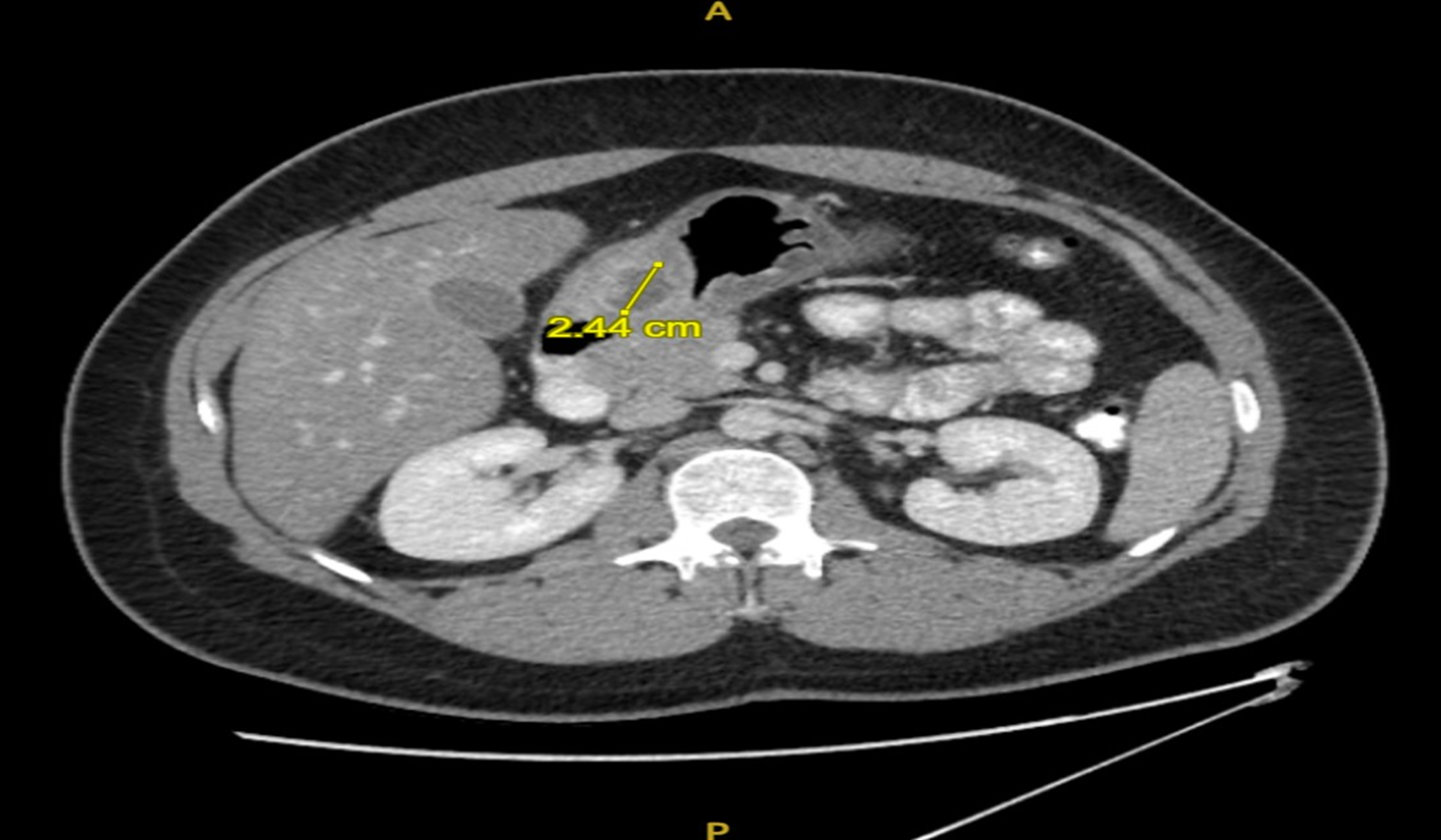 Rim-enhancing 2.4 cm fluid-containing structure is observed, including the anterior/caudal wall of the antrum of the stomach near the pylorus.