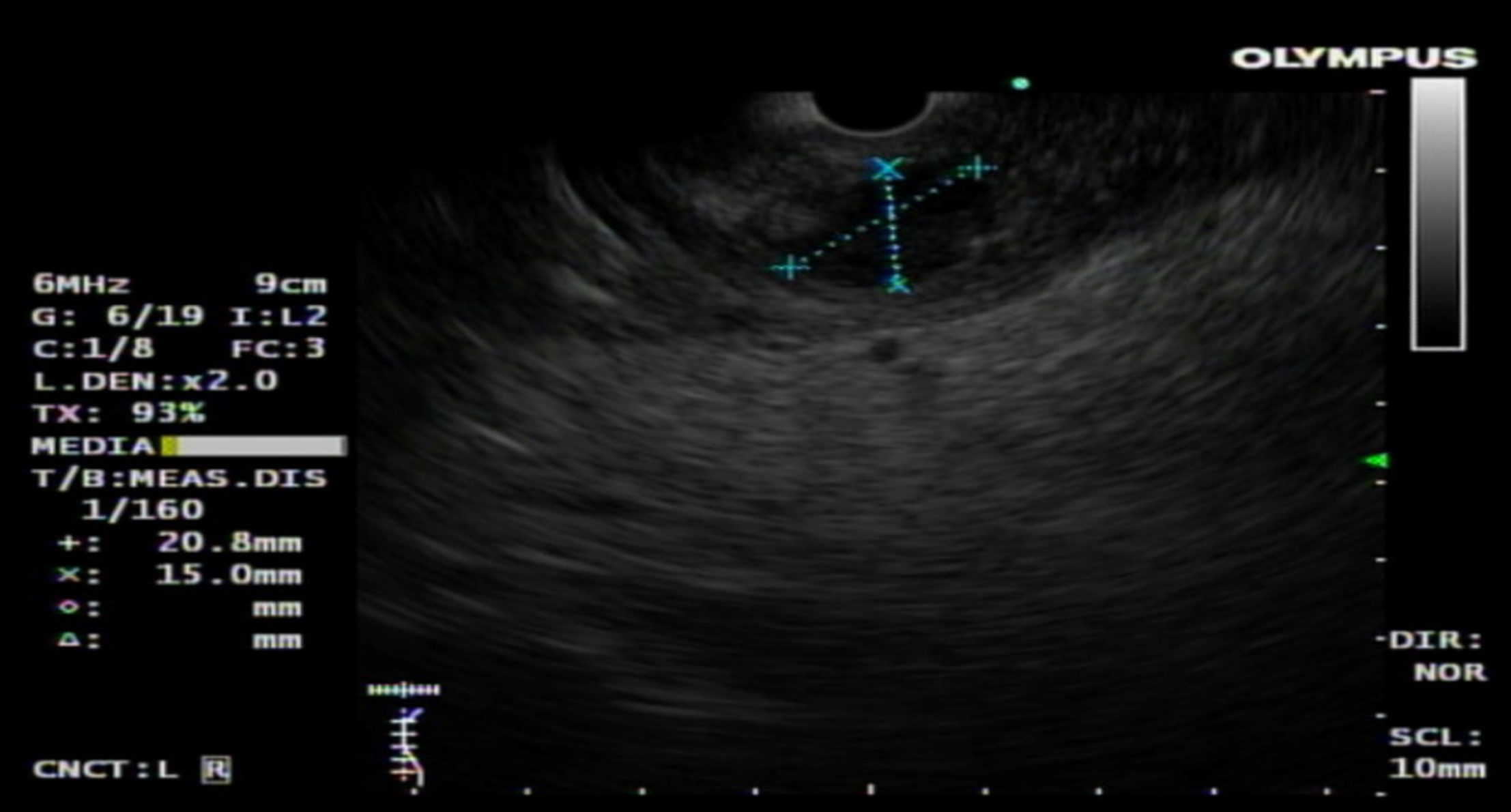 Irregular, oval, and anechoic cyst measuring 27 mm x 21 mm with debris present, well-defined margins, and smooth margins.