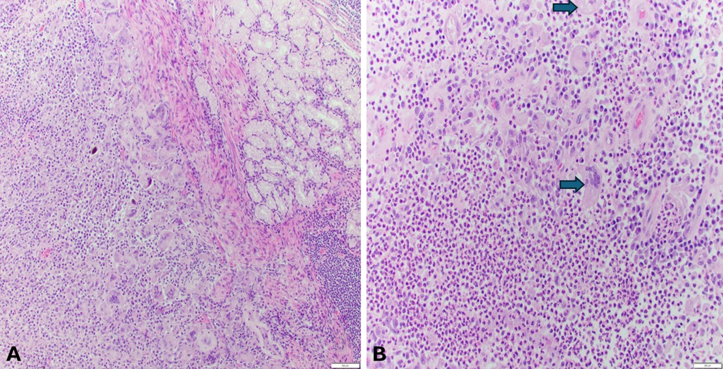 A: H&E, 10X: Brunner glands of the duodenum (upper right) with adjacent acute and chronic inflammation, including multinucleated giant cells consistent with abscess. B: H&E, 20X; Abundant neutrophils with scattered multinucleated giant cells (arrow).