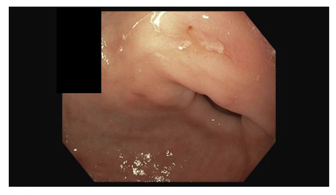 Esophagogastroduodenoscopy demonstrating a single 5-mm superficial gastric ulcer with a clean base (Forrest III) in the gastric antrum.