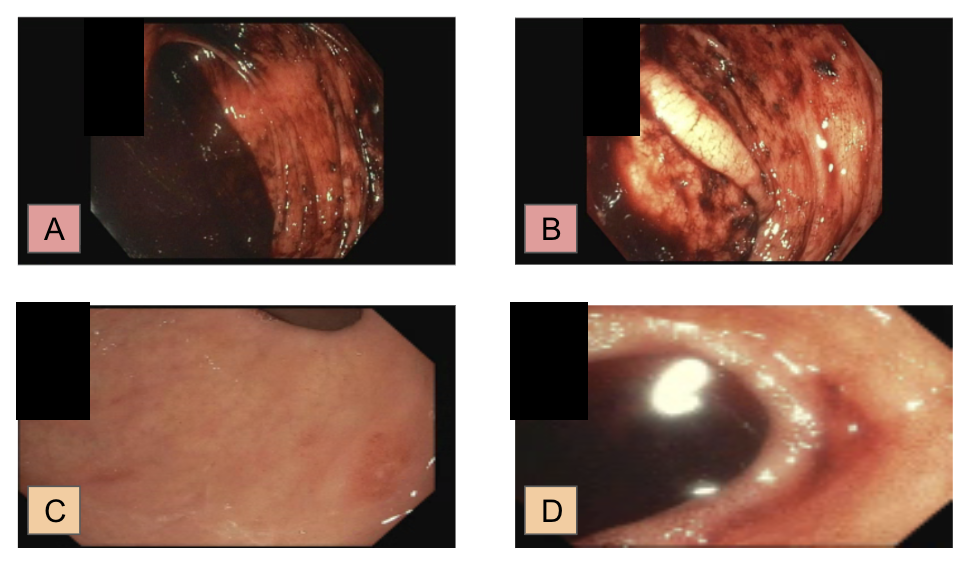 Colonoscopy demonstrating localization of the bleeding source to the small bowel. Panels A and B show fresh blood entering the cecum without an identifiable colonic lesion. Panels C and D demonstrate active bleeding within the terminal ileum, supporting suspicion for a small bowel source of hemorrha
