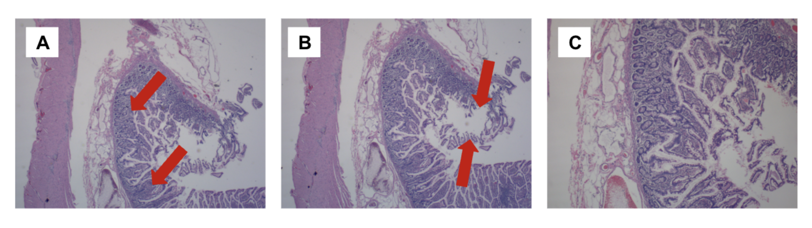 Histopathological examination of the resected Meckel’s diverticulum (H&E stain). (A) 20× magnification of gastric-type mucosa (arrows). (B) 20× magnification of ulcerated bleeding focus (arrows). (C) 40× magnification showing a higher-power view of the preceding finding.