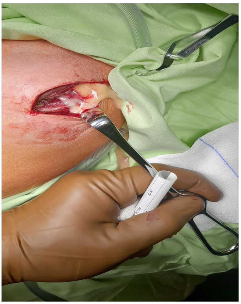 Presents pus leakage from abscess in the peri articular area of left shoulder.