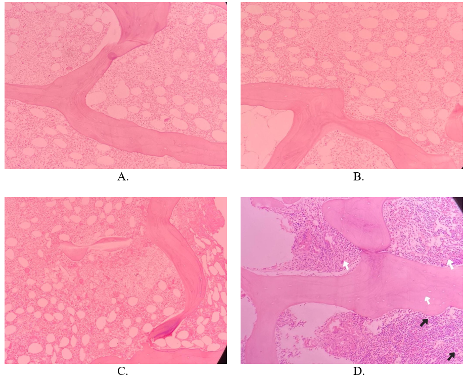Bone marrow biopsy showing bone marrow necrosis. Images A-C show several intratrabecular spaces showing bone marrow necrosis characterized by loss of cellular details with indistinct cellular borders and nuclear pyknosis with deposition of eosinophilic amorphous debris. In image D, the white arrows