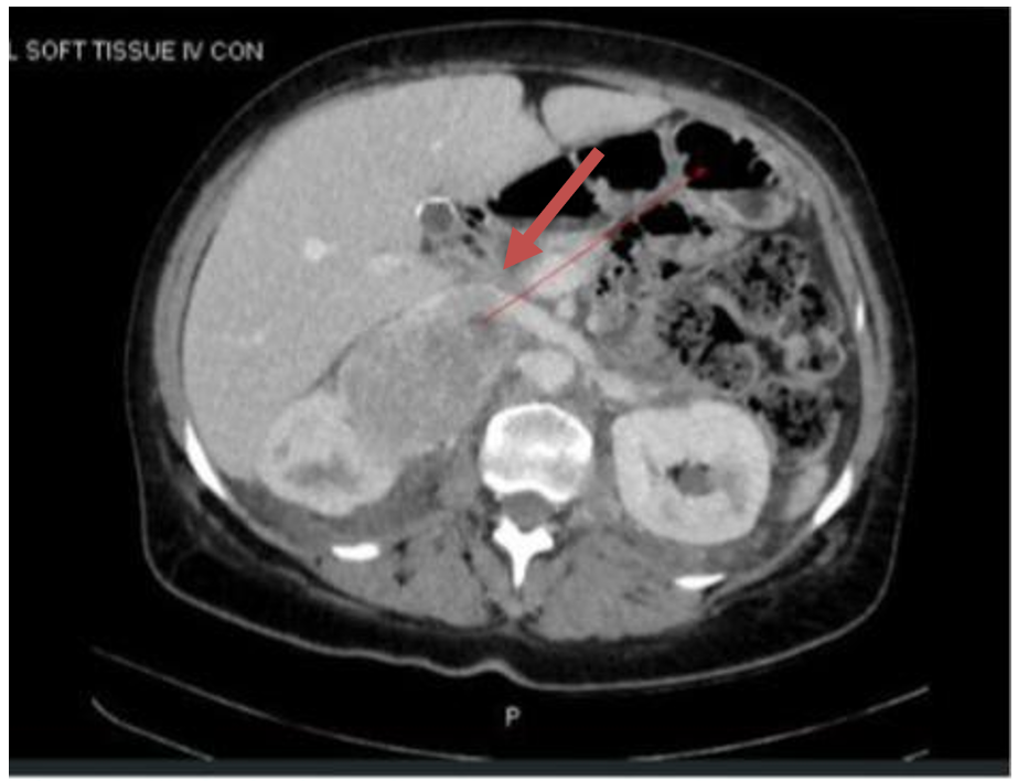 CT showing large right adrenal tumour nearly 12 cm in size – at the time of initial phaeochromocytoma diagnosis.