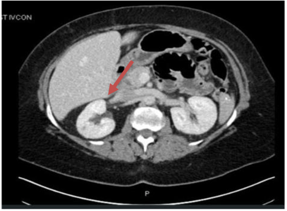 Follow-up CT status post resection of right adrenal phaeochromocytoma, showing complete resection of the mass.