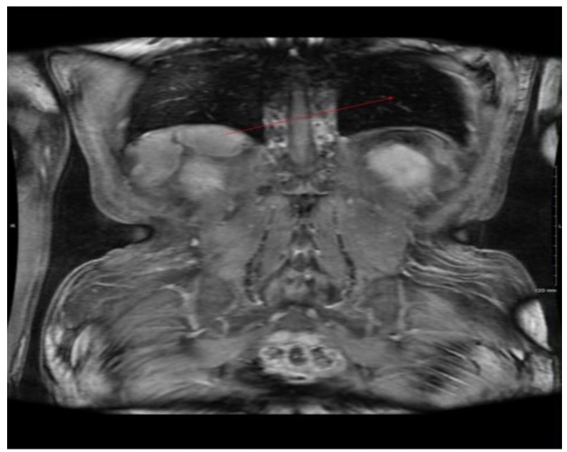 CT coronal section showing soft tissue nodules in the right posterior pararenal space suspicious for recurrent phaeochromocytoma.