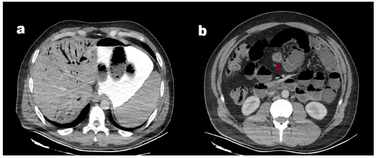 Multiple air foci in the main portal vein and its branches with shadows in the superior mesenteric vein (SMV). (a) Multiple air foci within the intrahepatic portal venous branches. (b) Air shadows observed in the superior mesenteric vein (arrow), air-fluid levels in the small intestine, and pneumato