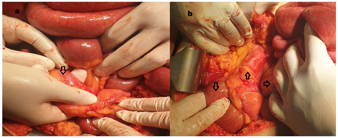 Mesenteric defect in the left colon and herniated small bowel. (a) Mesenteric defect in the left colon (arrow\downarrow), with the surgeon’s fingers passing through the defect in the left mesentery. (b) Mesenteric defect in the left colon showing terminal ileum (arrow\downarrow), left colon (arrow\u