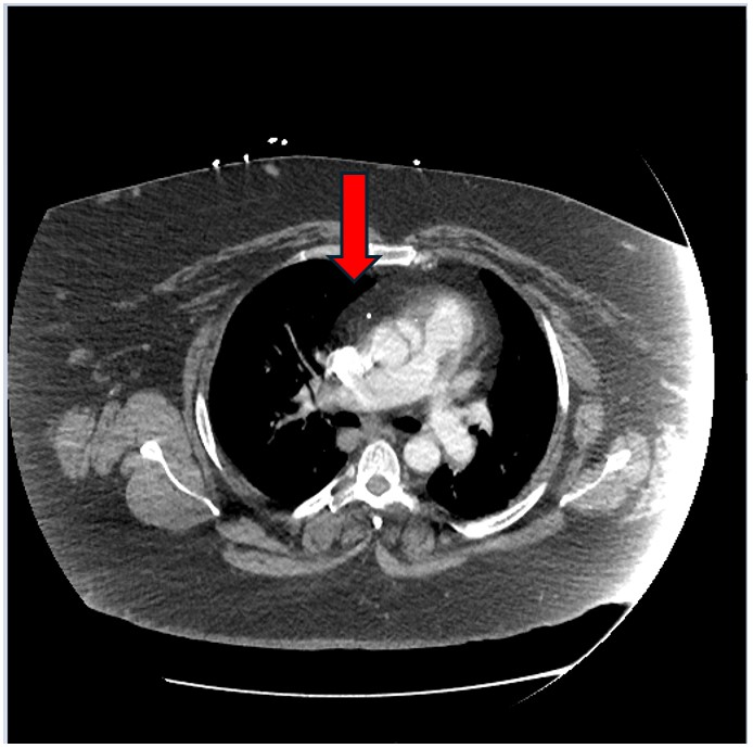 Contrast CT images in transverse plane consistent with false lumen flap (red arrow), a finding consistent with aortic dissection. Imaging is also remarkable for thicker than normal subcutaneous tissue and fat.