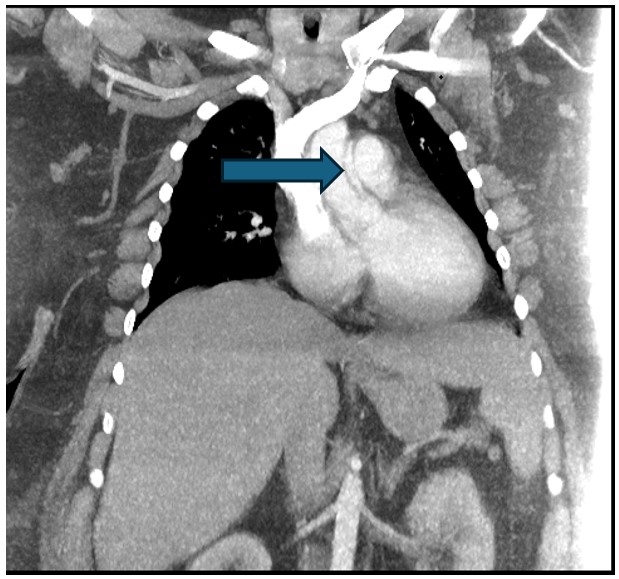 Contrast CT images in coronal plane suggestive of a type-A aortic dissection false lumen flap (blue arrow).