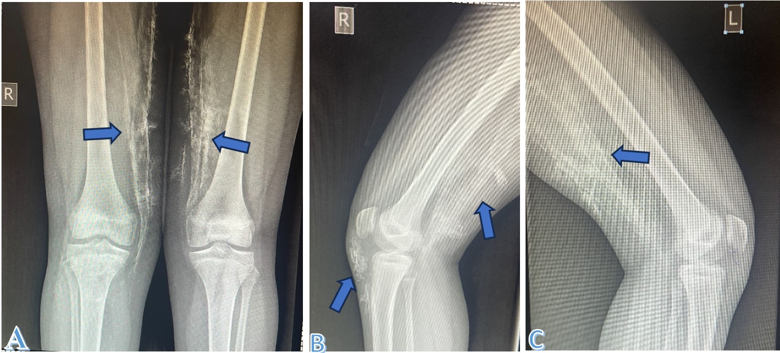 (A) Anteroposterior radiograph showing extensive soft tissue calcifications (arrows). (B, C) Lateral radiographs demonstrating widespread periarticular calcific deposits (arrows).
