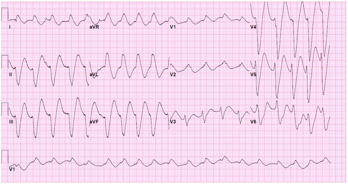 12-lead ECG at hour 0, corresponding to the onset of wide-complex tachycardia prior to oral sodium bicarbonate administration. Paper speed: 25 mm/s; calibration: 10 mm/mV. The patient exhibits slow monomorphic ventricular tachycardia with HR 130 bpm, PR interval 200 ms, QRS 140 ms, QT 520 ms, and JT