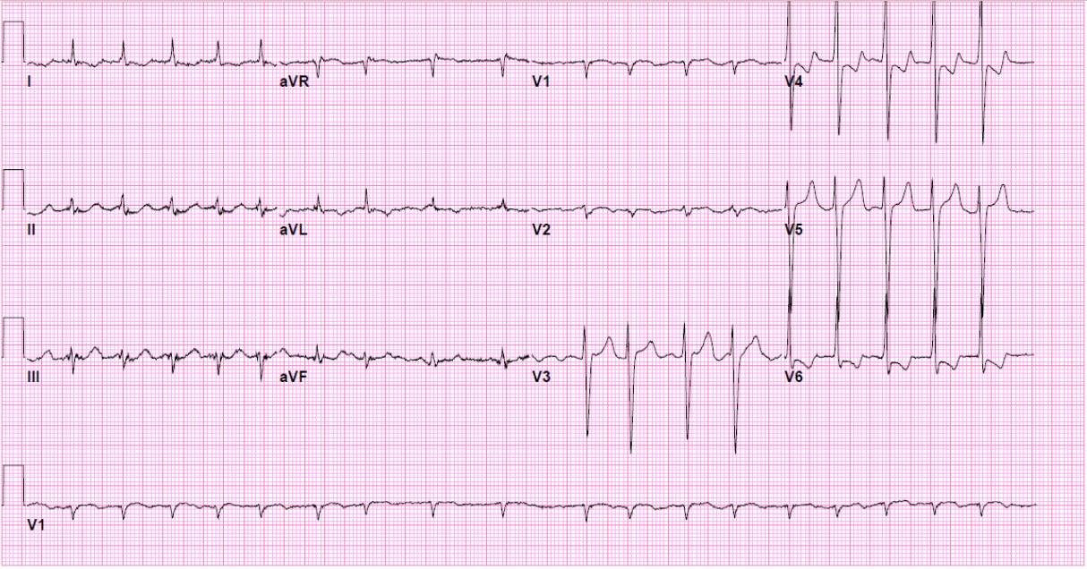 12-lead ECG at hour +4, approximately one hour after initiation of oral sodium bicarbonate (950 mg TID). Paper speed: 25 mm/s; calibration: 10 mm/mV. The patient reverted to baseline paroxysmal atrial fibrillation. Heart rate 100 bpm, PR interval 180 ms, QRS 115 ms, QT 430 ms, and JT 315 ms (calcula